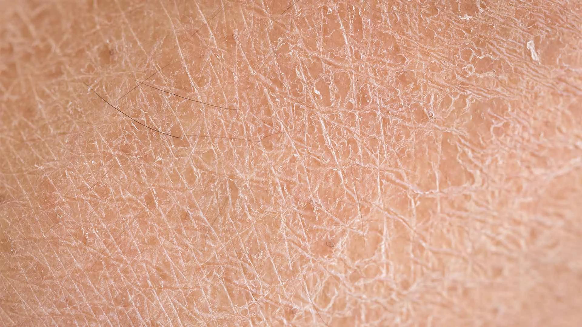Dehydrated vs Dry Skin in India: Your FAQ Answered