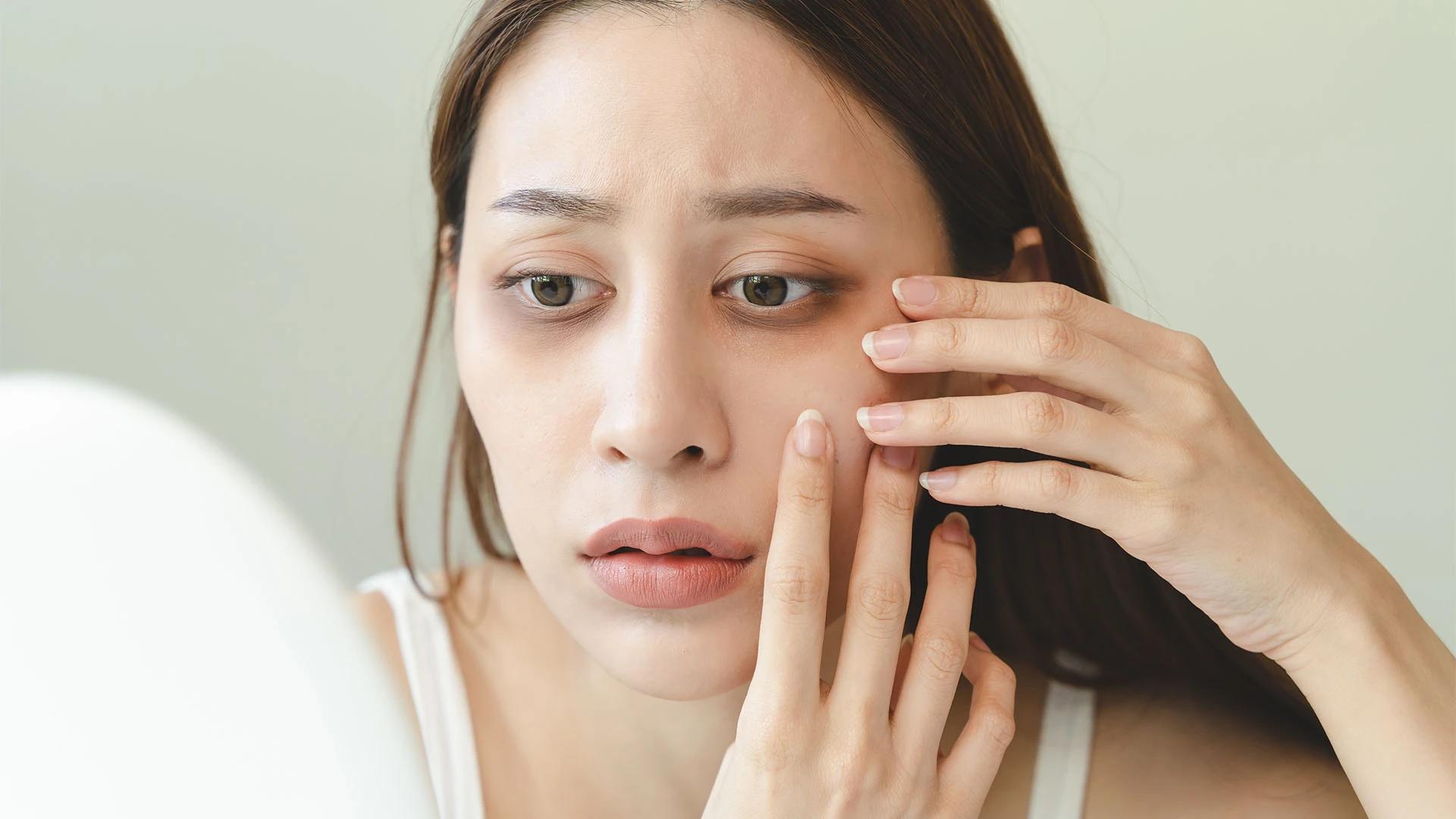 12 Proven Home Remedies for Dark Circles & Under Eye Bags