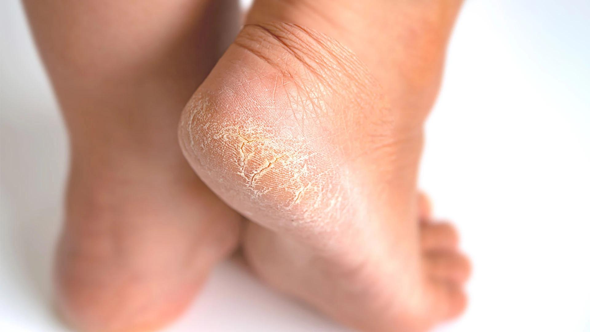 7 Proven Ways to Heal Cracked Heels This Winter