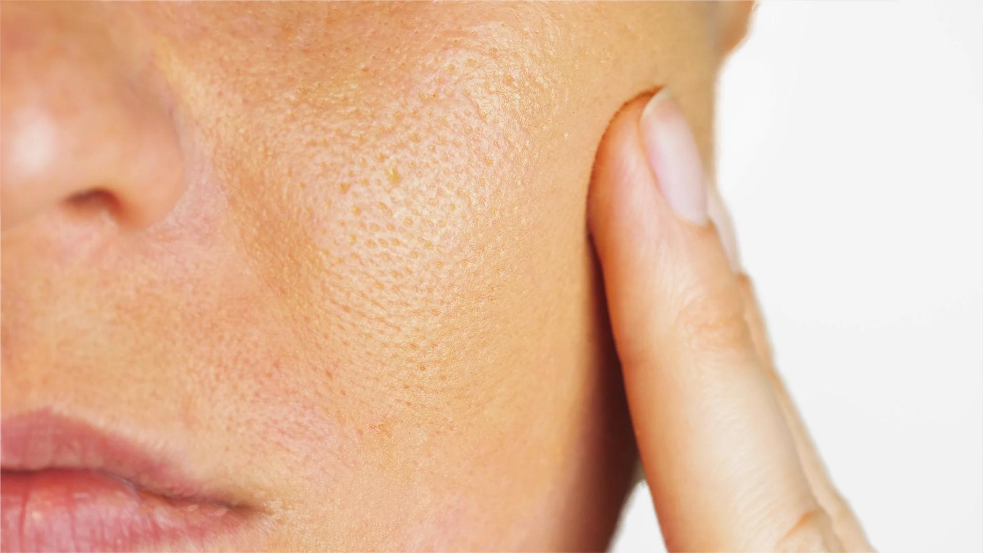 7 Proven Tips to Minimize Open Pores on Face Naturally