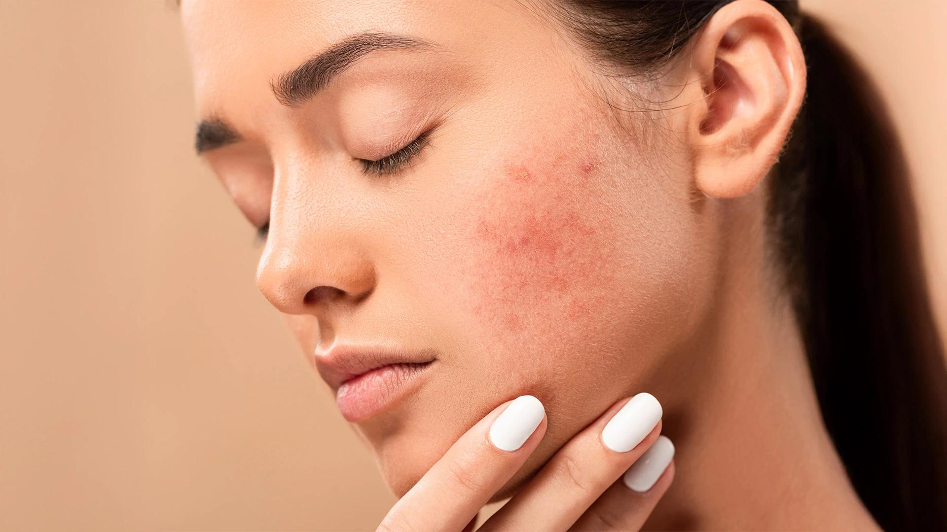 8 Proven Tips to Banish Blemishes on Face Naturally