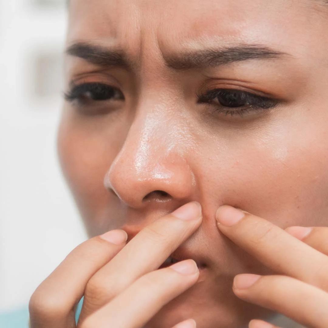 9 Proven Tips to Effectively Remove Black Spots on Face
