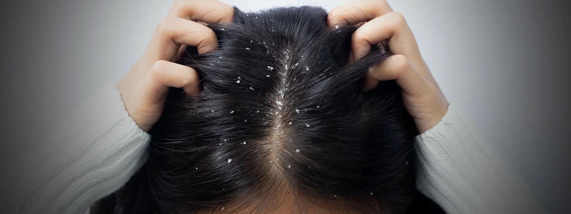 9 Top Anti Dandruff Shampoo Reviews for Itchy Scalp Relief