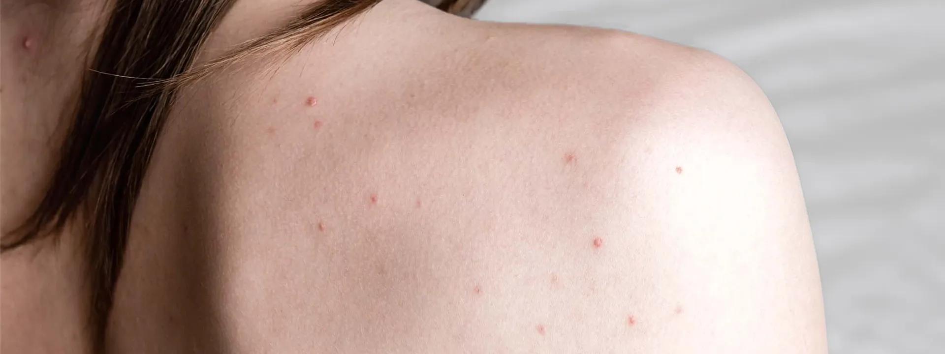 9 Ways to Clear Body Blemishes: Back, Chest, & Butt Acne Solutions