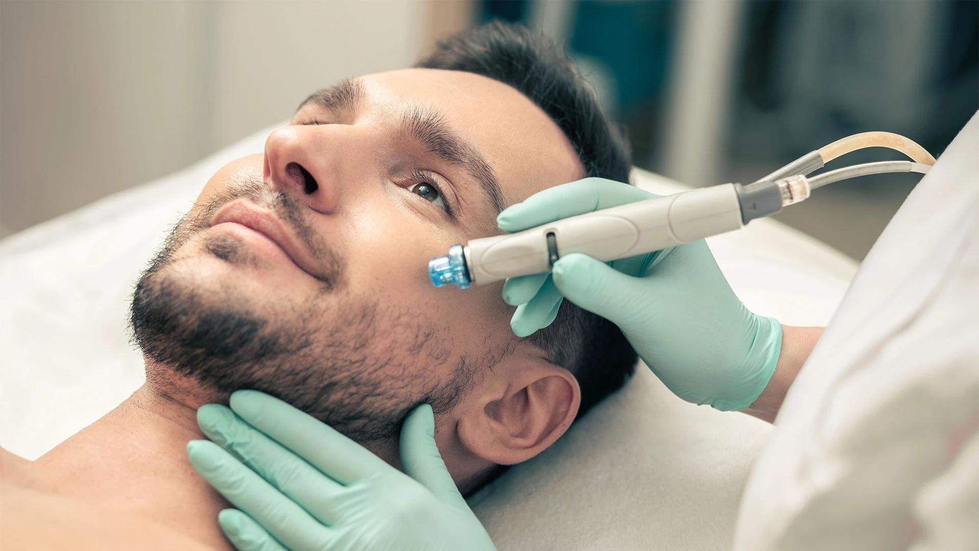 9 Ways to Treat Acne Scars for Men