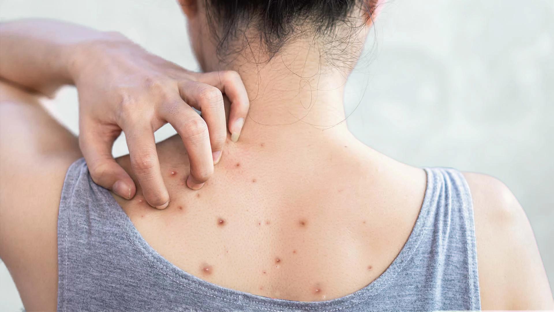 Indian Skin Pimple Popping FAQ: Scar Prevention & Safe Removal