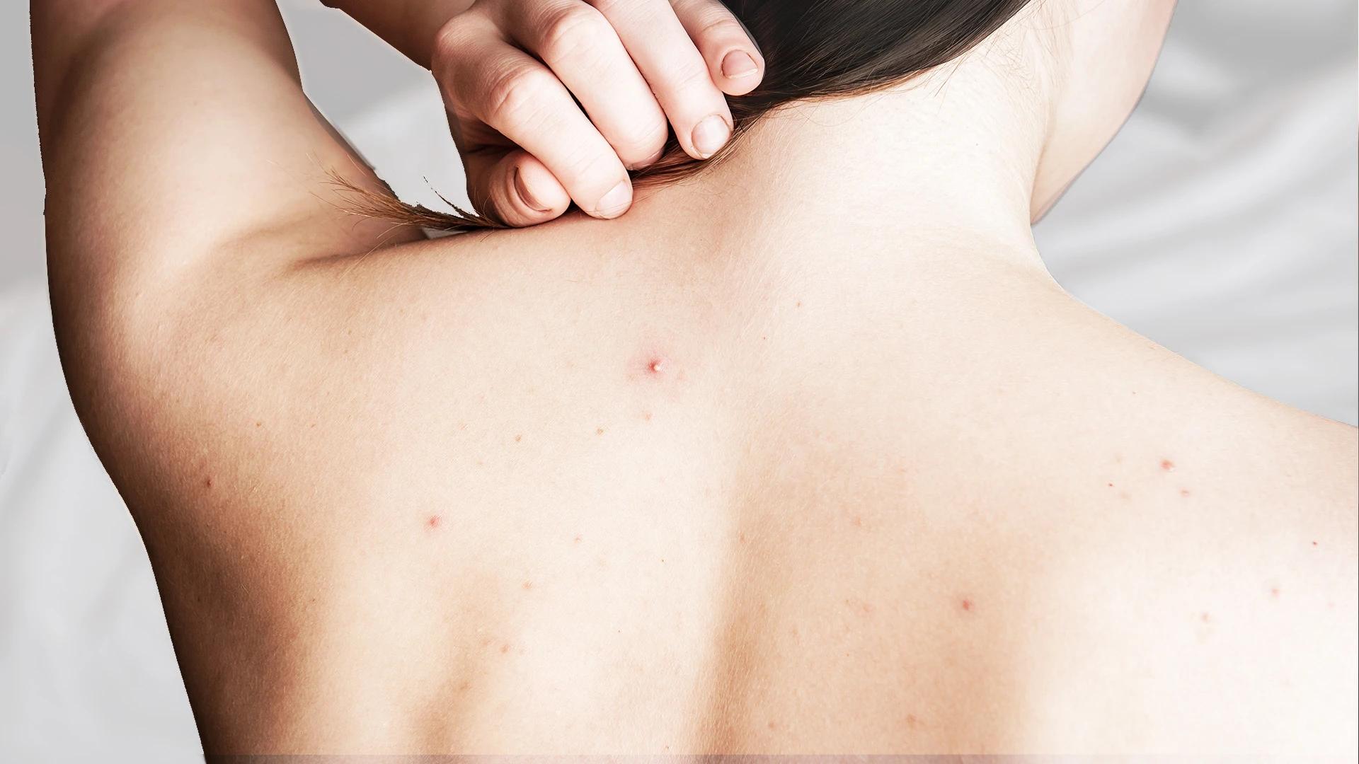 How to Use Salicylic Acid for Body Acne on Chest and Back