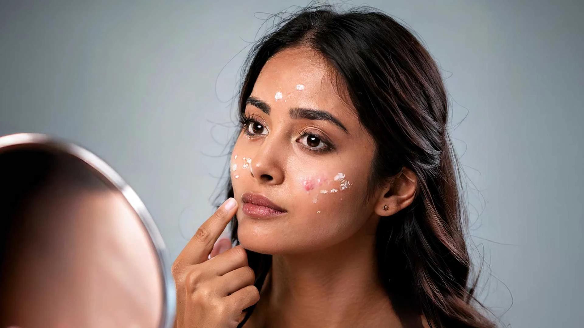 Anti Acne Night Cream for Monsoon FAQ: Your Questions Answered