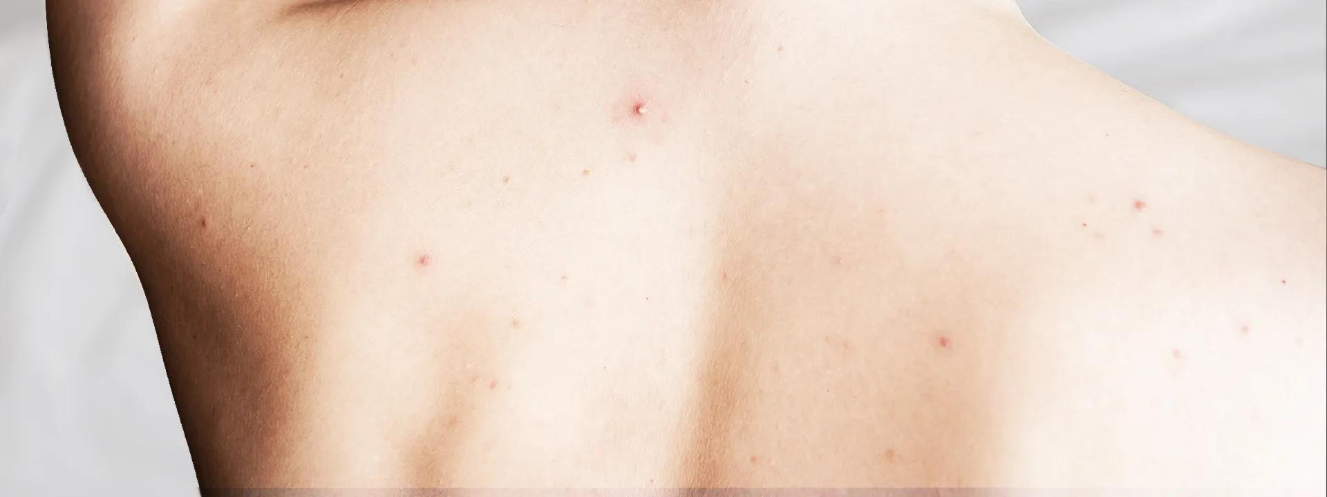 Body Breakouts Prevention Routine Men: FAQ