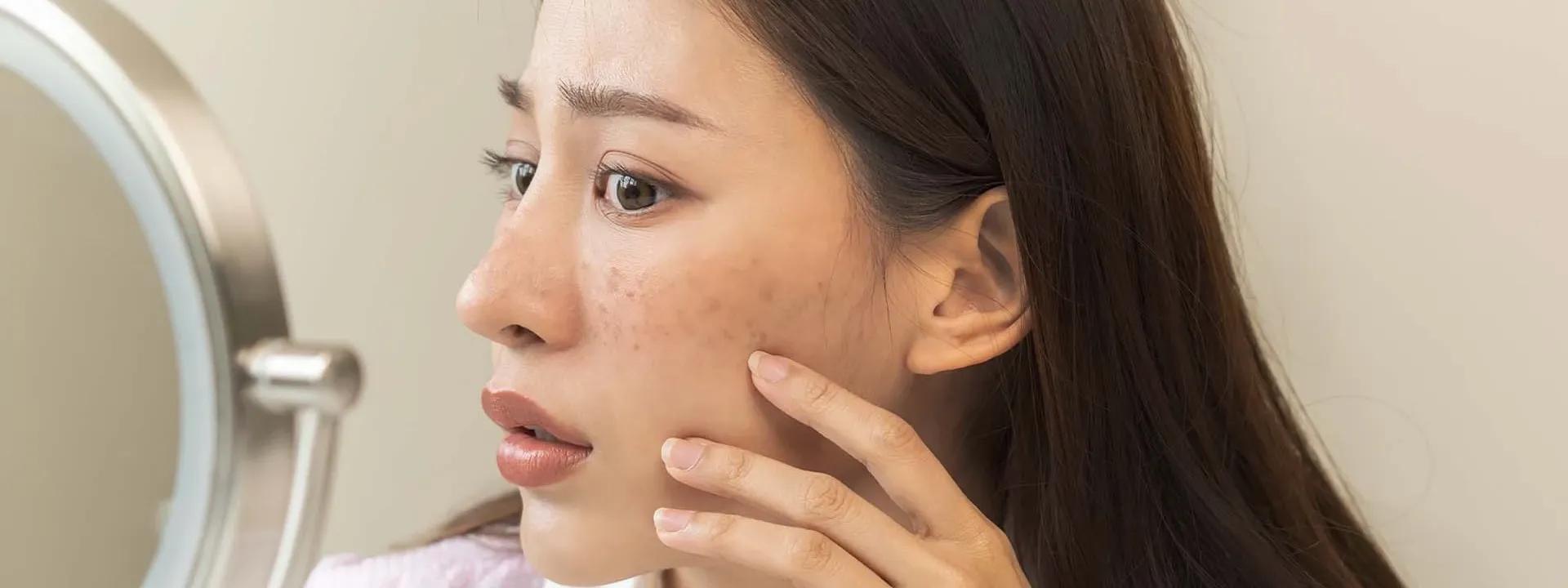 Dark Spots in India FAQ: Natural Removal & Hyperpigmentation Treatment