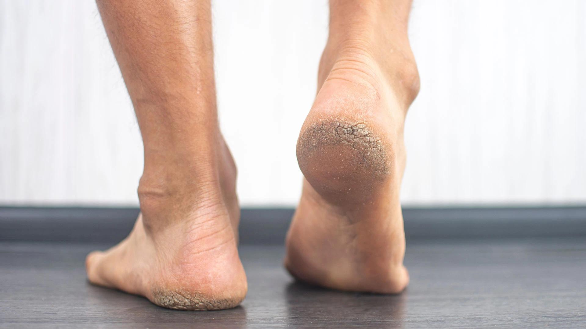 Heel Balm for Cracked Heels FAQ: Your Dry Feet Questions Answered