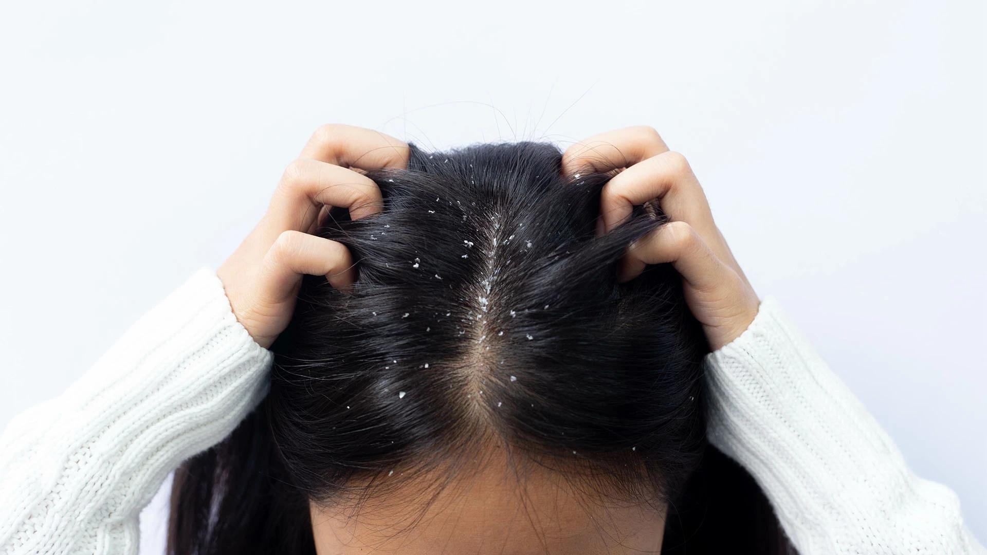 How Dandruff Flakes Develop: Understanding Root Causes