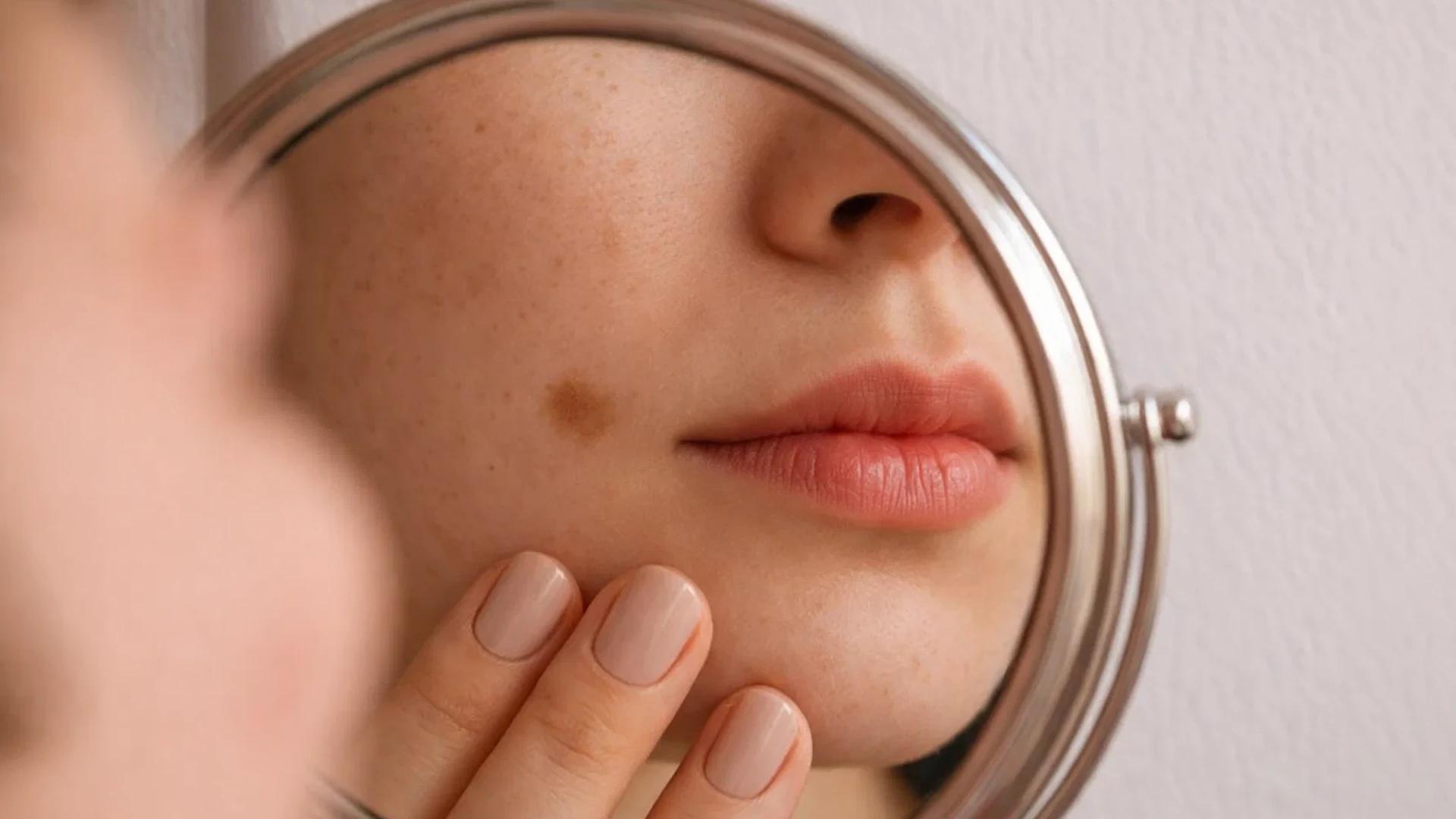 How Eczema Presents on Indian Skin & Its Triggers