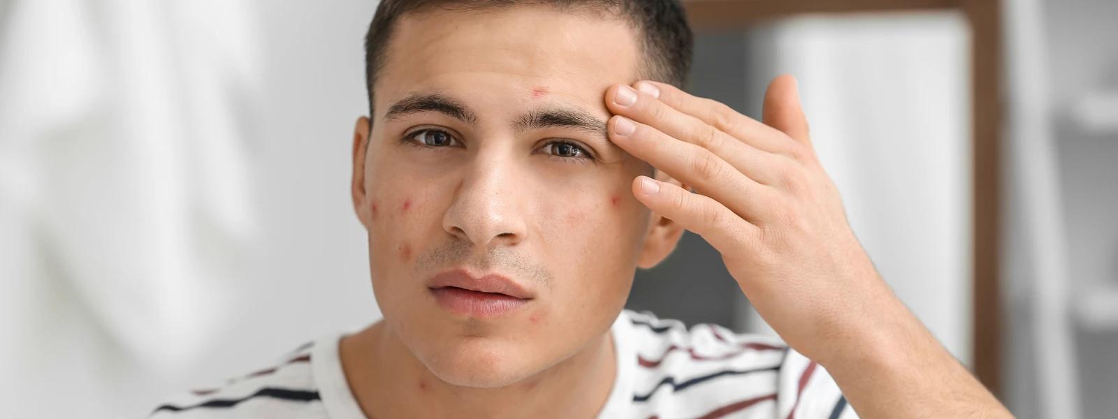 How Face Washes Target Pimples and Dark Spots for Men
