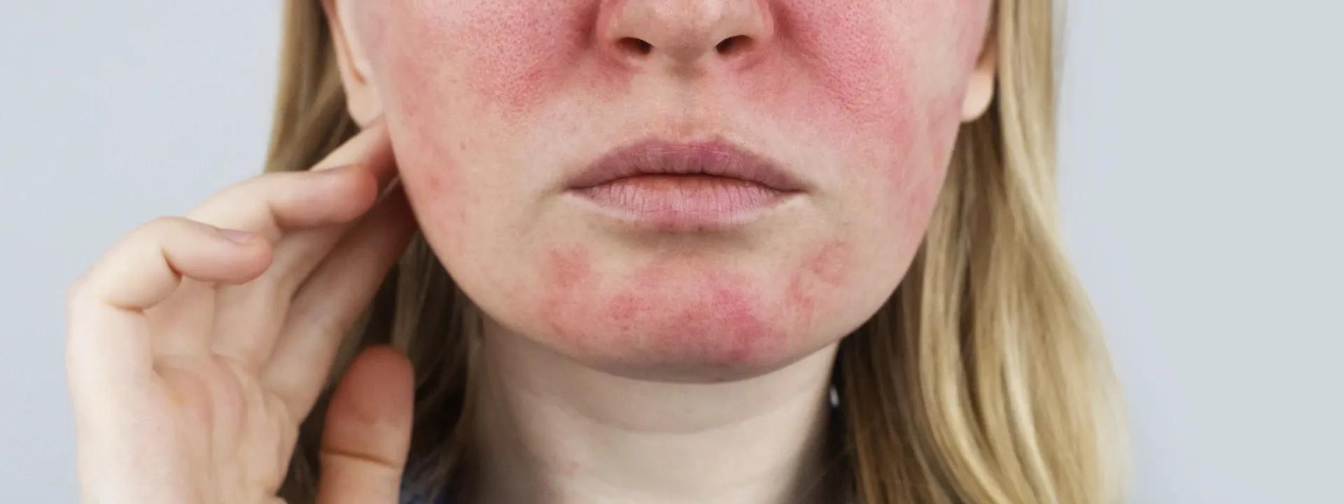 How to Calm Facial Redness Fast: Quick Fixes for Blotchy Skin