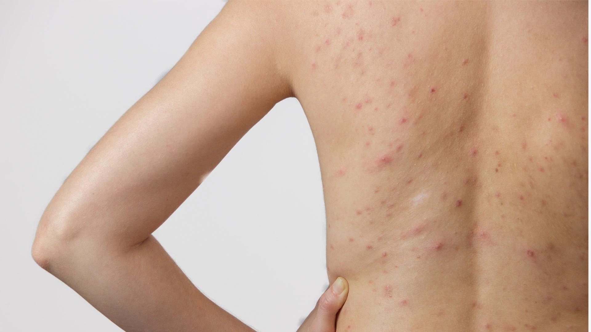 How to Combat Acne in Humid Weather Effectively