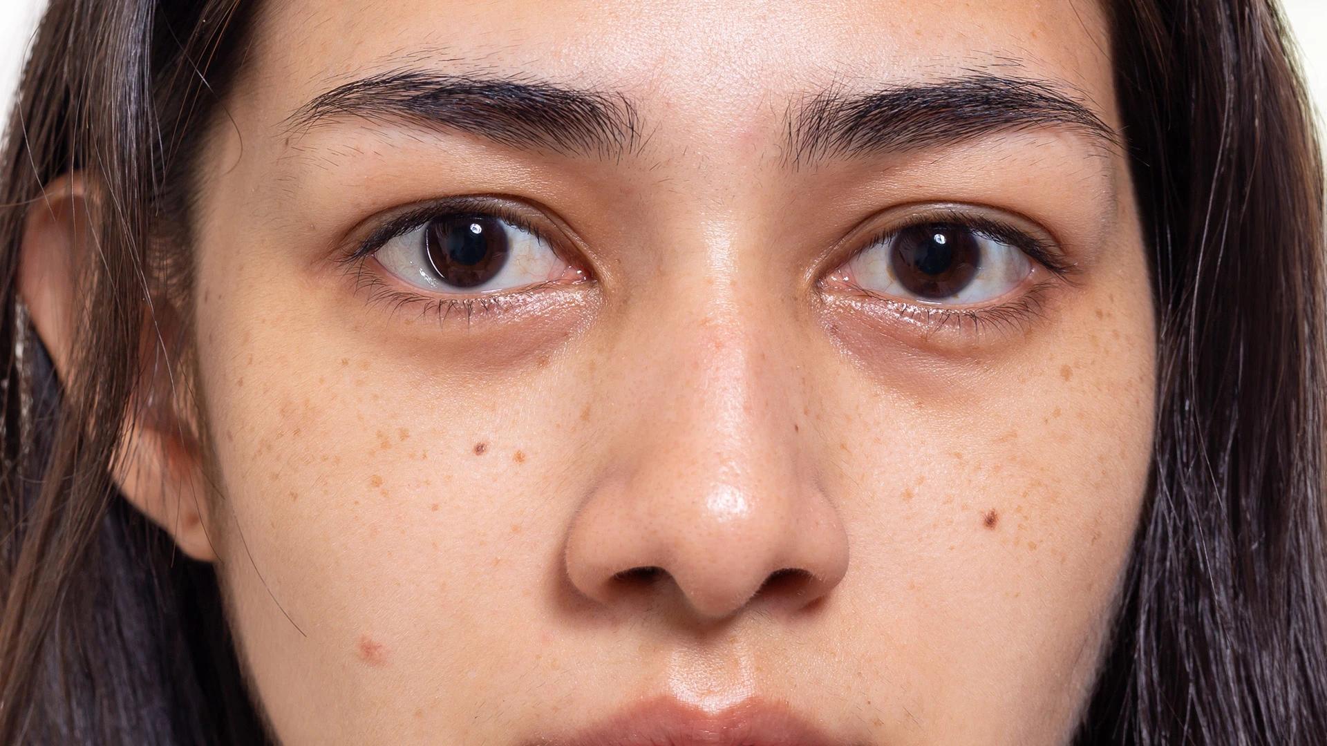 How to Effectively Treat Dark Spots on Female Skin