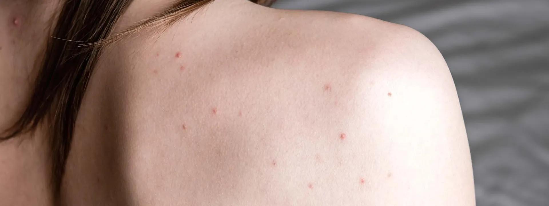 How to Get Rid of Back Acne Naturally: Fast Home Remedies