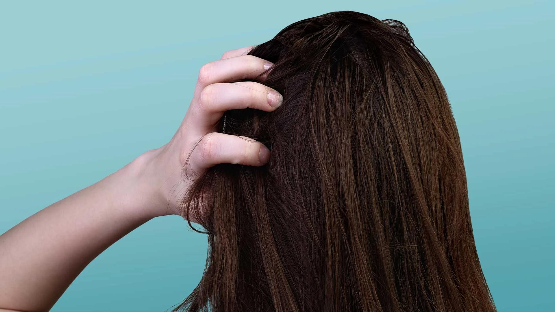 How to Get Rid of Flaky Scalp: Dry Itchy Scalp Remedies