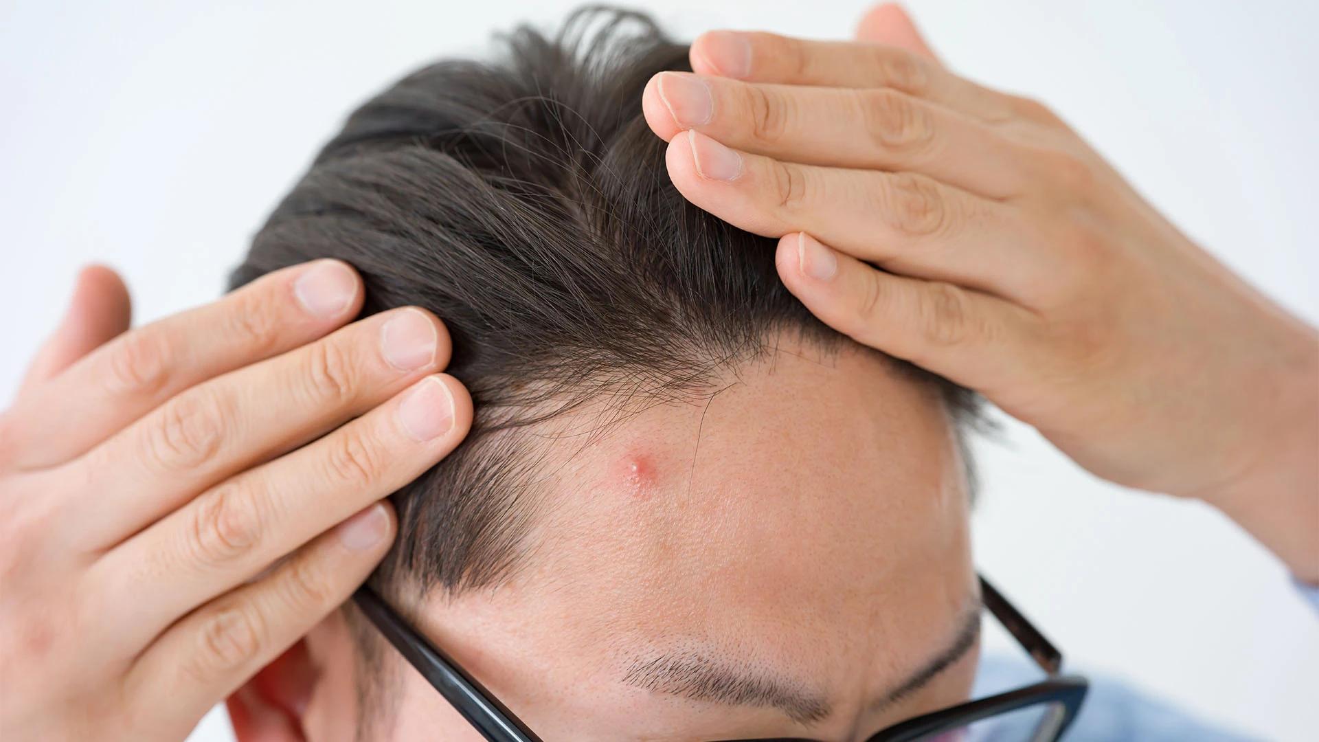 How to Get Rid of Maskne for Men: Clear Skin Fast