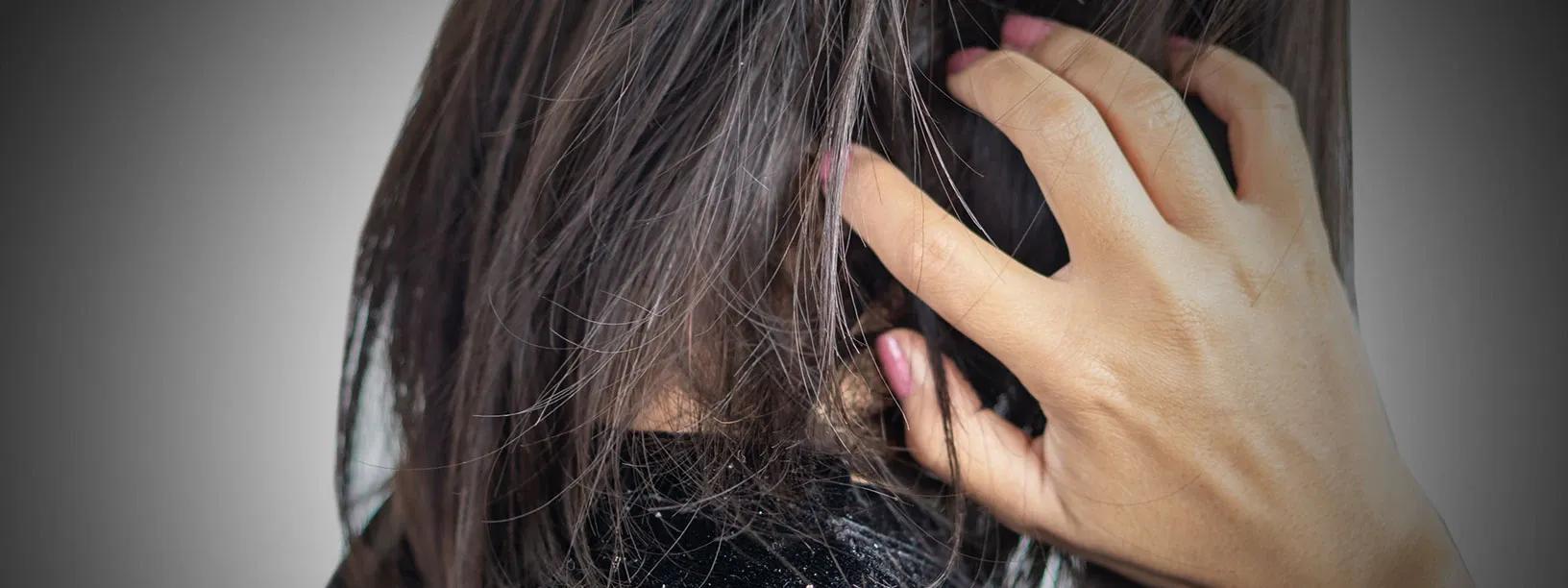 How to Get Rid of Scalp Dandruff: Quick & Easy Remedies