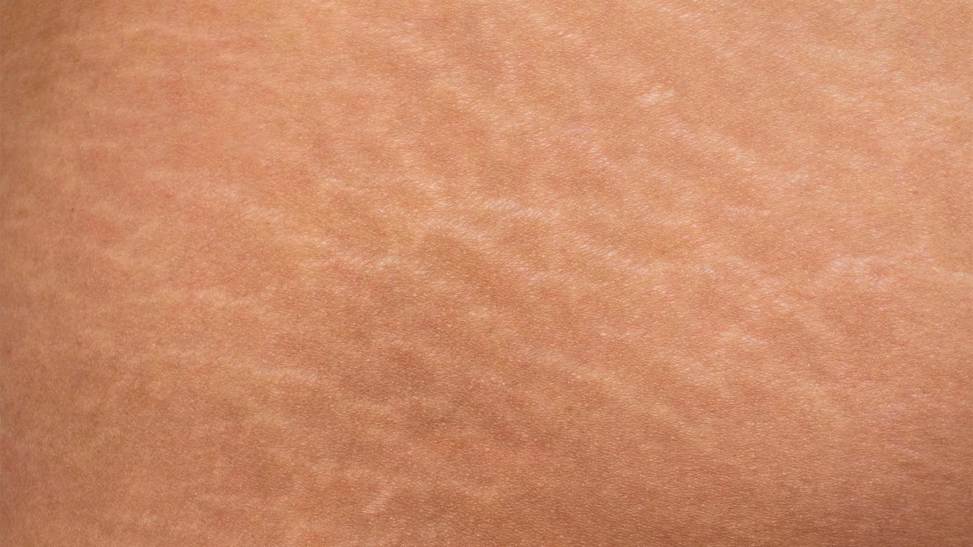 How to Get Rid of Thigh Chafing: Quick Relief & Prevention