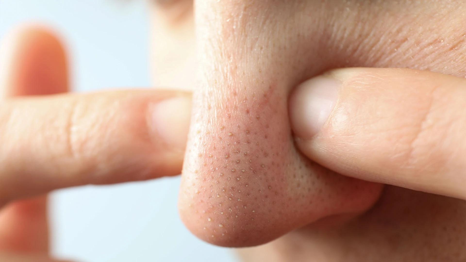 How to Quick Pore Flush for Men: Unclog Pores Effectively