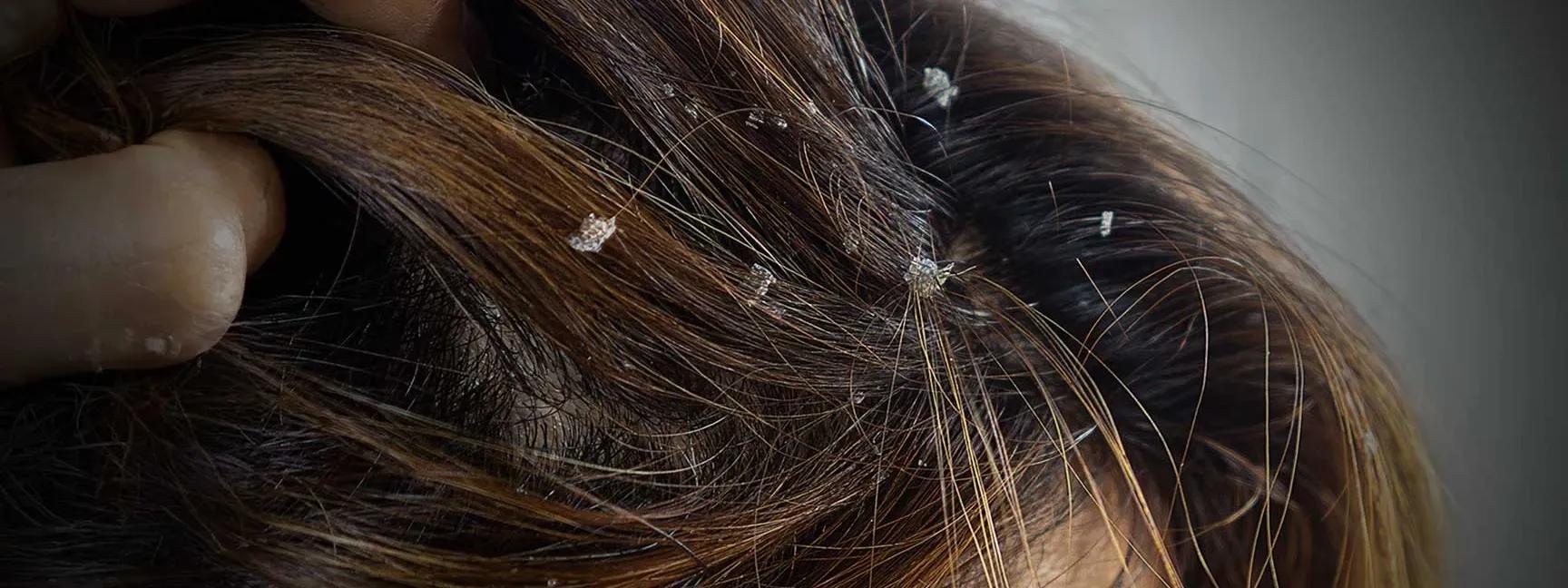 How to Stop Dandruff in Humidity: Your Scalp's Best Friend