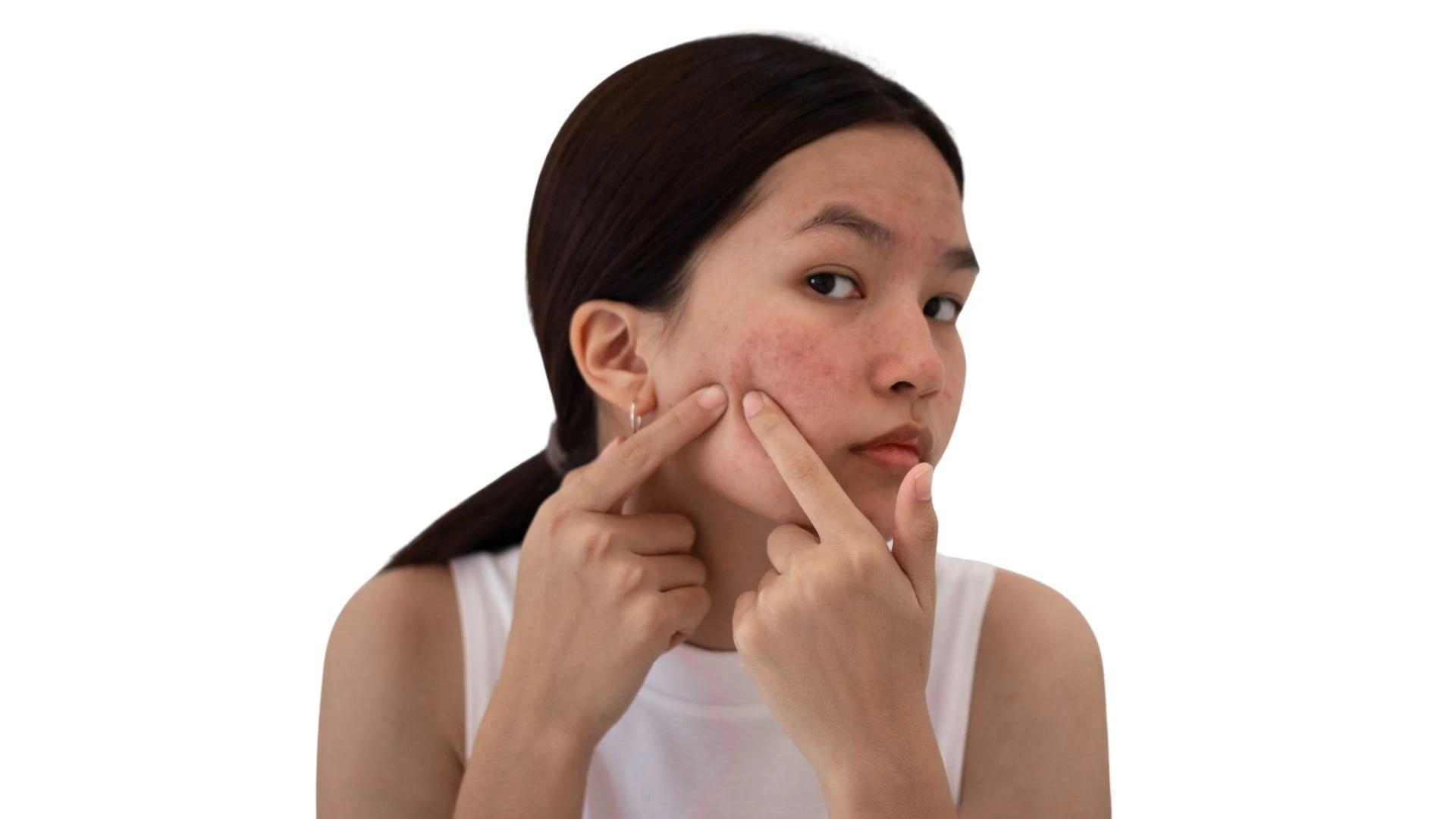 How to Treat Pigmentation Around Chin: Expert Tips