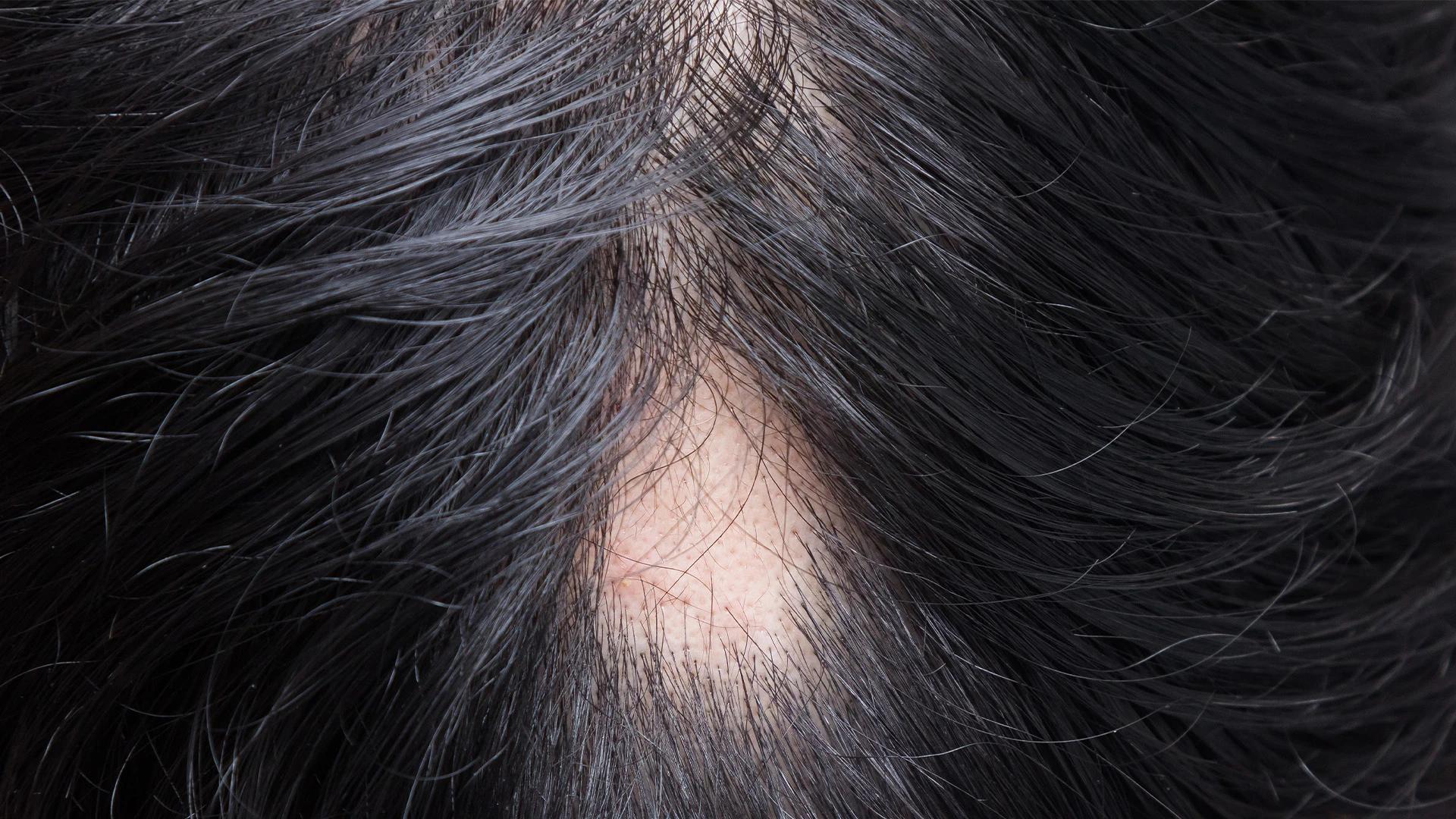 How to Use Home Remedies for Hair Thinning Naturally