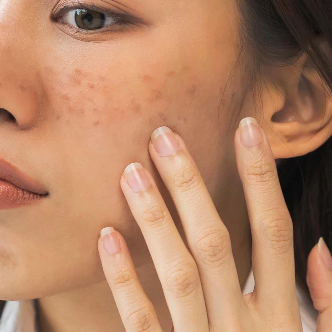 How to Use Kojic Acid for Stubborn Sun Spots