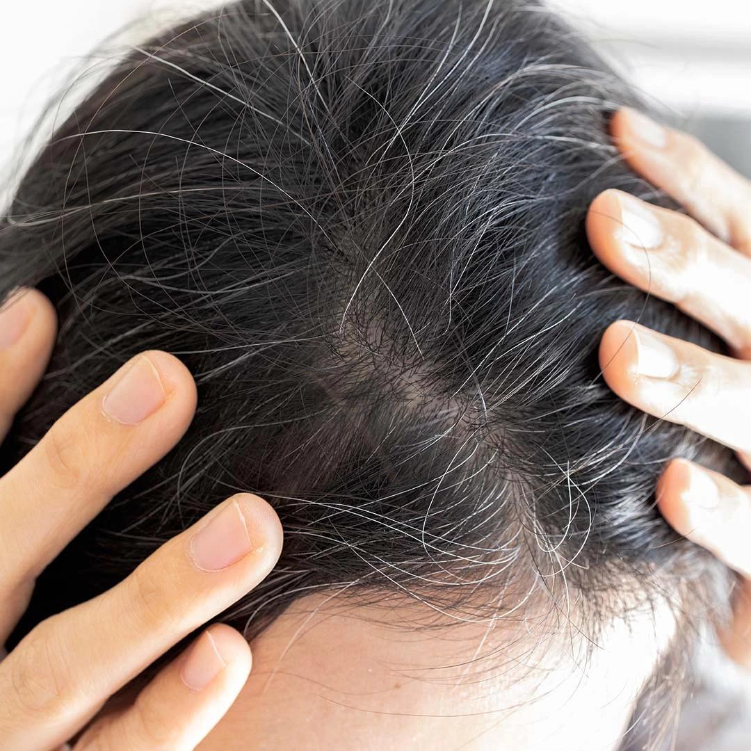 Monsoon Itchy Flaky Scalp FAQ: Common Questions Answered