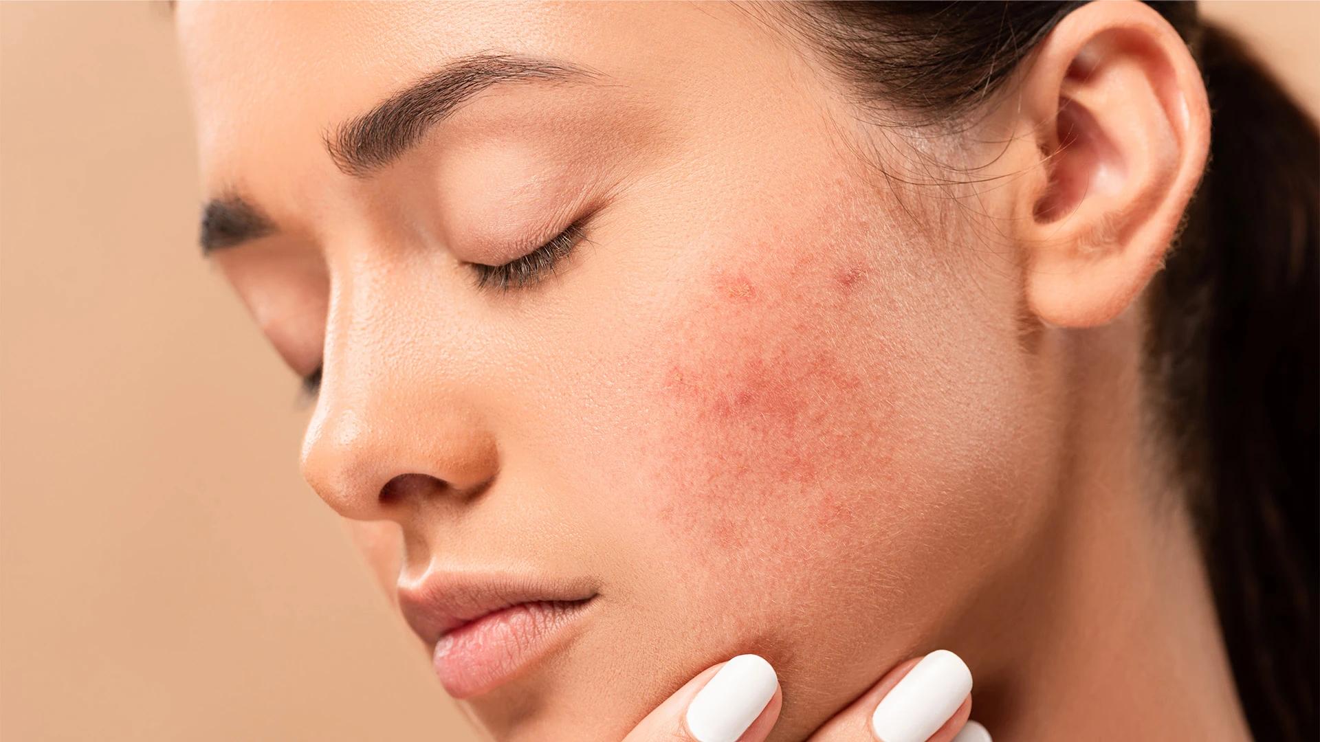 Perioral Hyperpigmentation on Indian Skin: FAQ