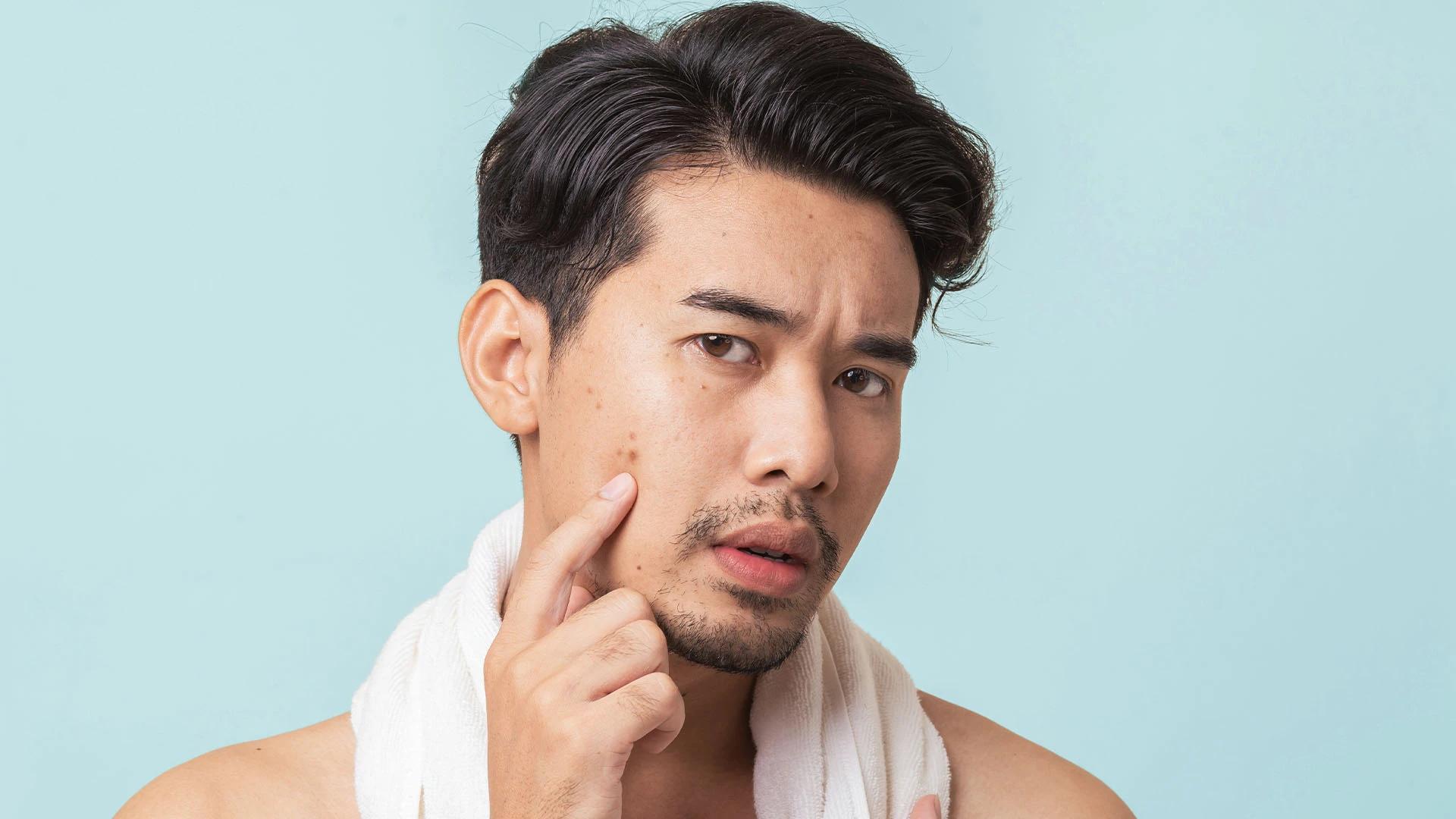 Pigmentation Remove Treatment FAQ: Your Questions Answered