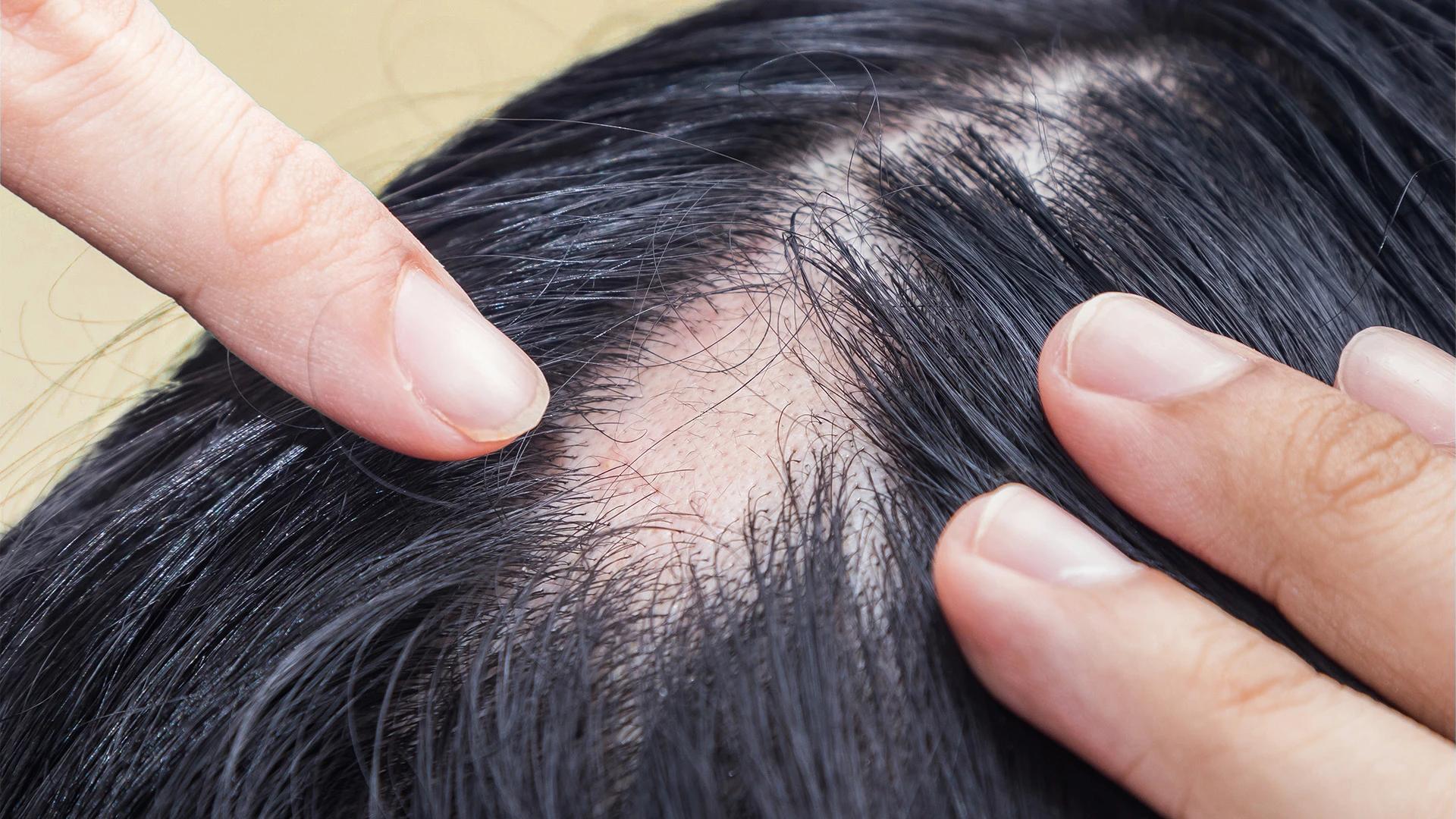 Seasonal Hair Fall Causes FAQ: Understanding Hair Shedding Seasons