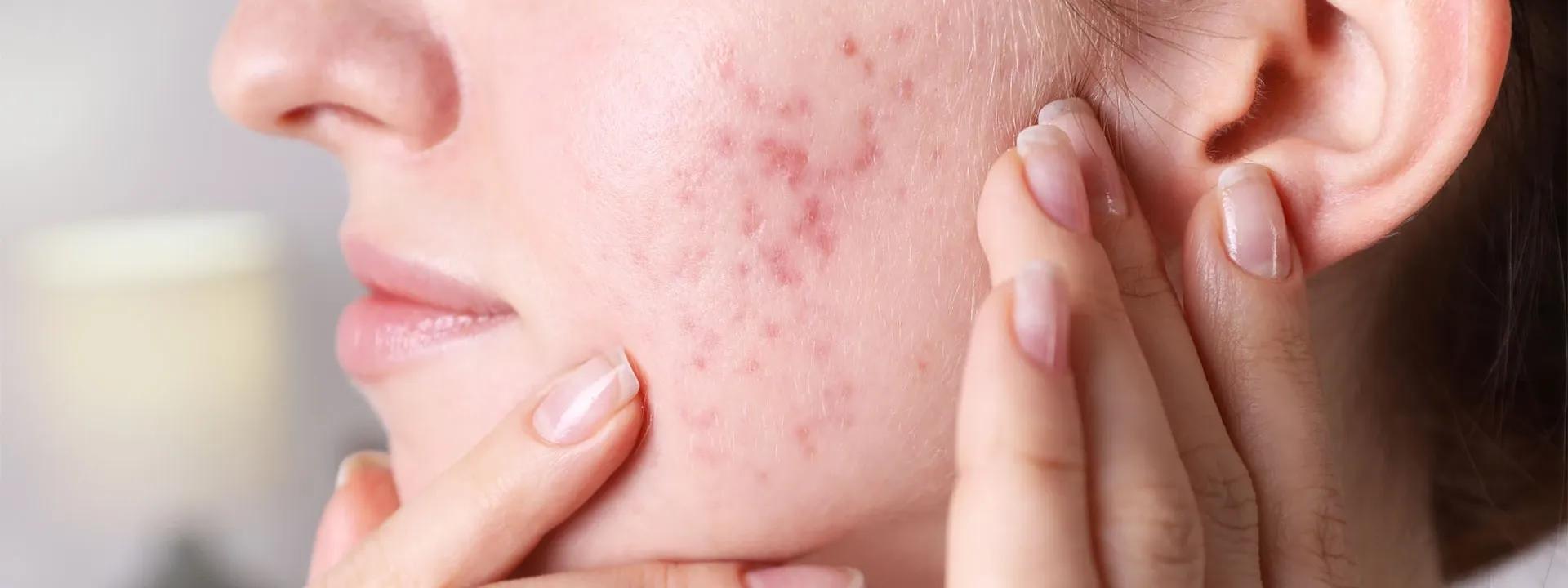 Signs of Impaired Skin Barrier Function FAQ: Common Questions Answered