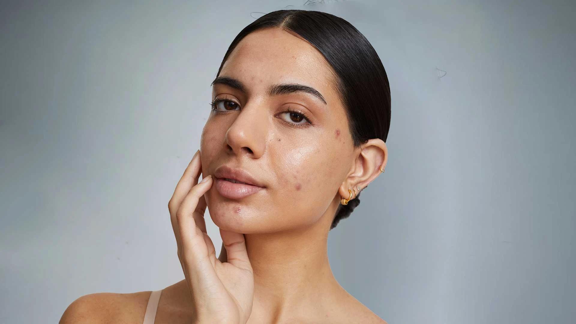 Skin Purging vs Breakout FAQ: What's the Difference?