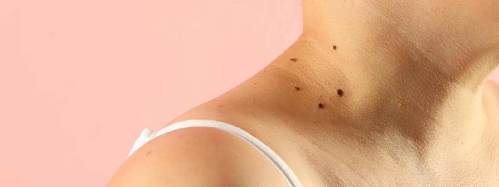 Body Acne on Indian Skin FAQ: Causes and Solutions