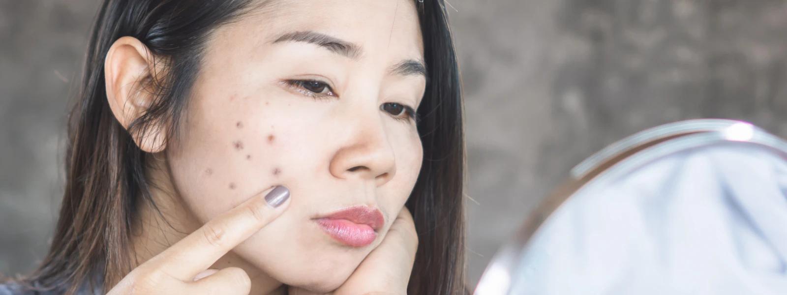Dark Spots FAQ: Your Ultimate Hyperpigmentation Treatment Guide