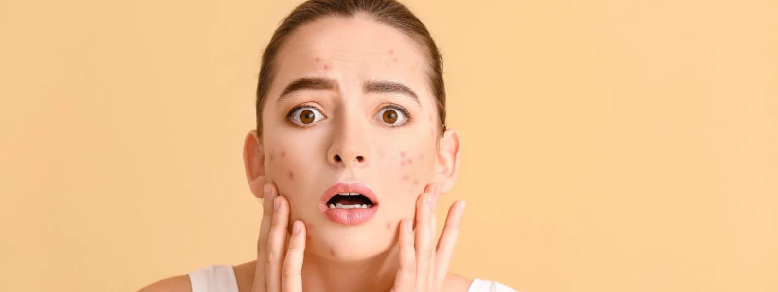 Dark Spots in Indian Teens FAQ: Causes & Fixes for Hyperpigmentation