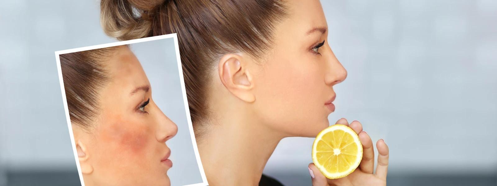 Dermatologist vs DIY Skincare: Can Lemon Home Remedies Worsen Issues?