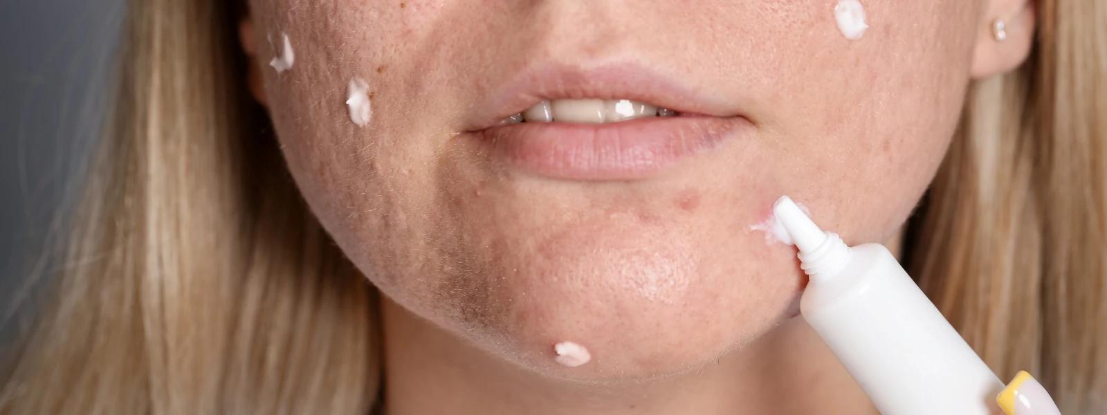 Essential Checklist for Fading Skin Patches & Hyperpigmentation Treatment