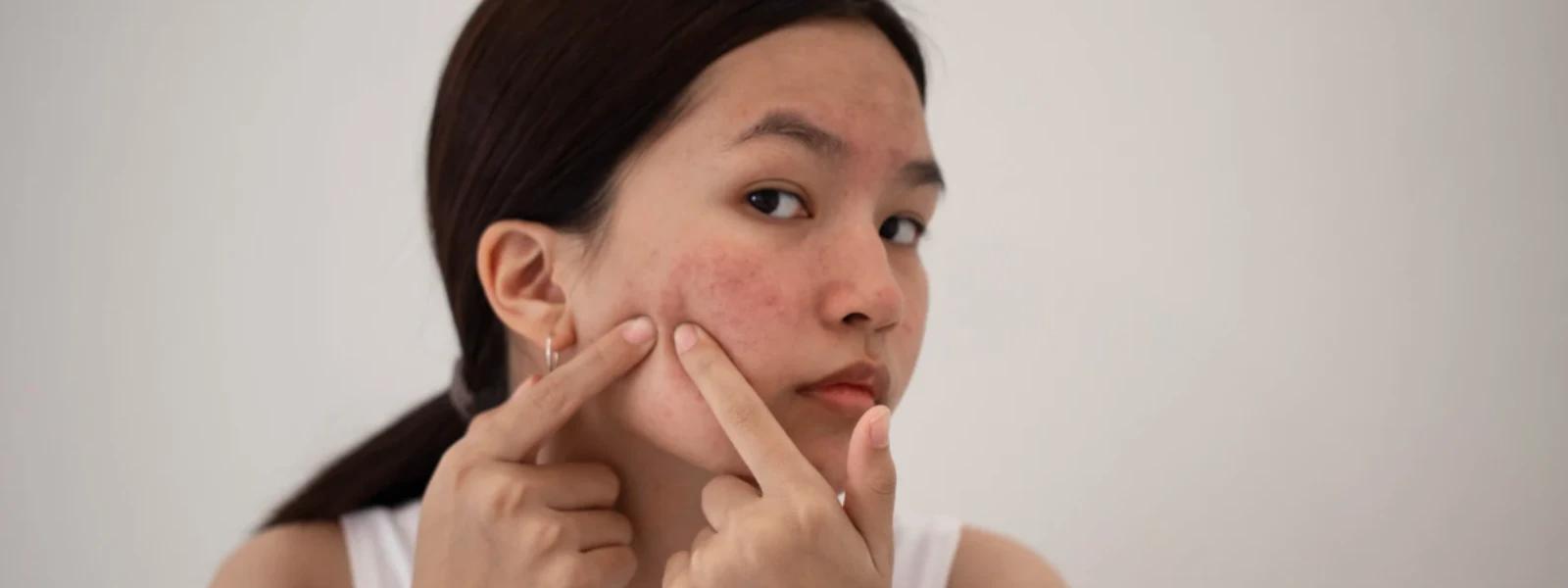 How to Fade Dark Spots After Pimples: A Complete Guide