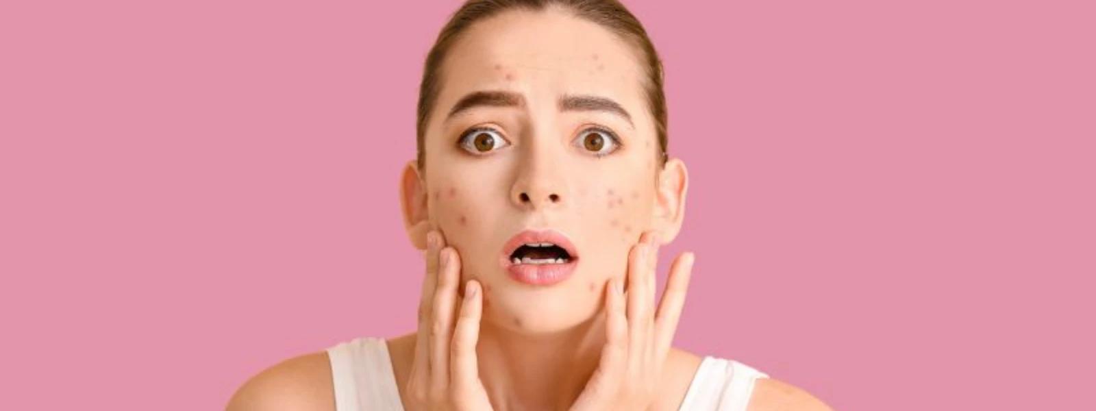 How to Get Rid of Dark Spots on Face Naturally