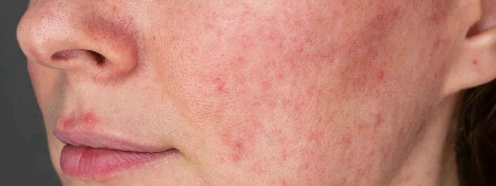 How to Reduce Dark Spots on Face: Your Complete FAQ