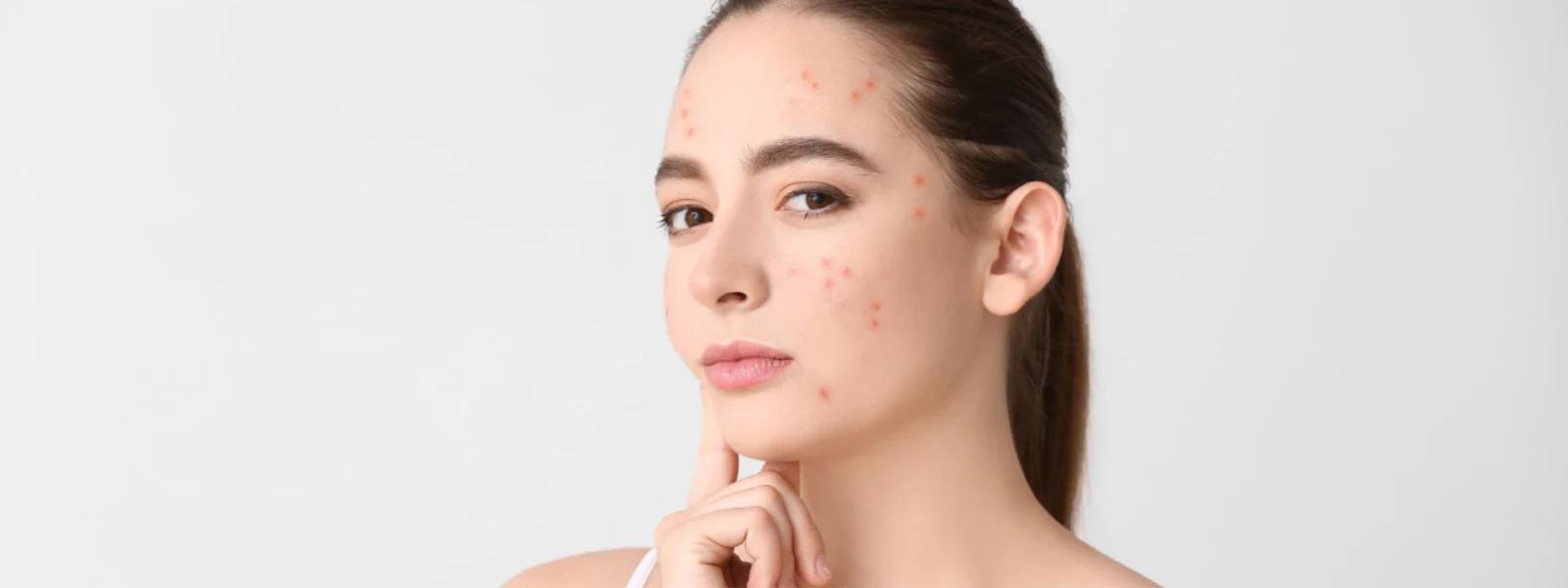 How to Remove Dark Spots on Face Fast: Quick & Effective Methods