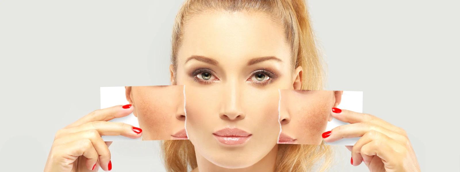How to Treat Hyperpigmentation for Even Skin Tone