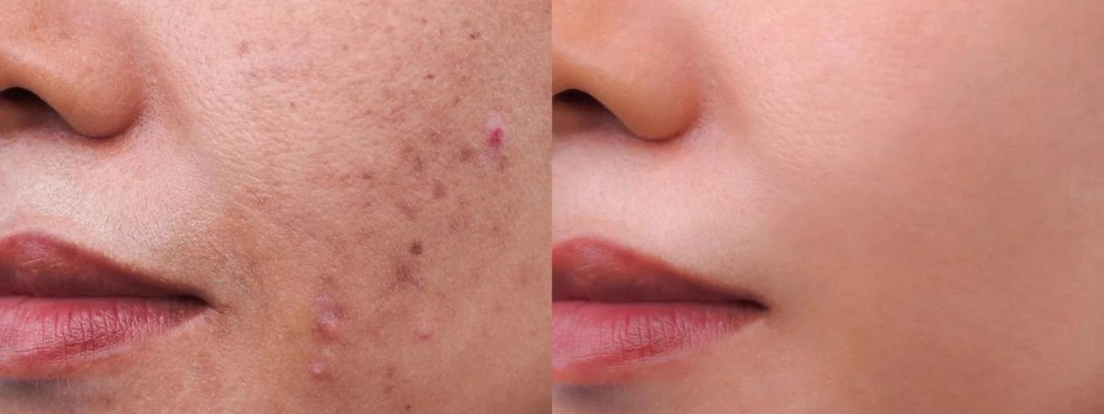 Post Acne Redness FAQ: Everything About PIE Treatment