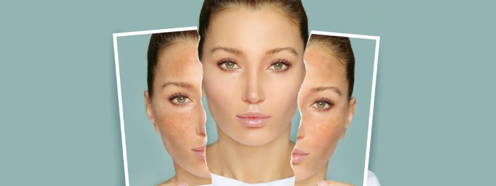 Hyperpigmentation Face FAQ: Your Guide to Dark Spots & Uneven Skin Tone