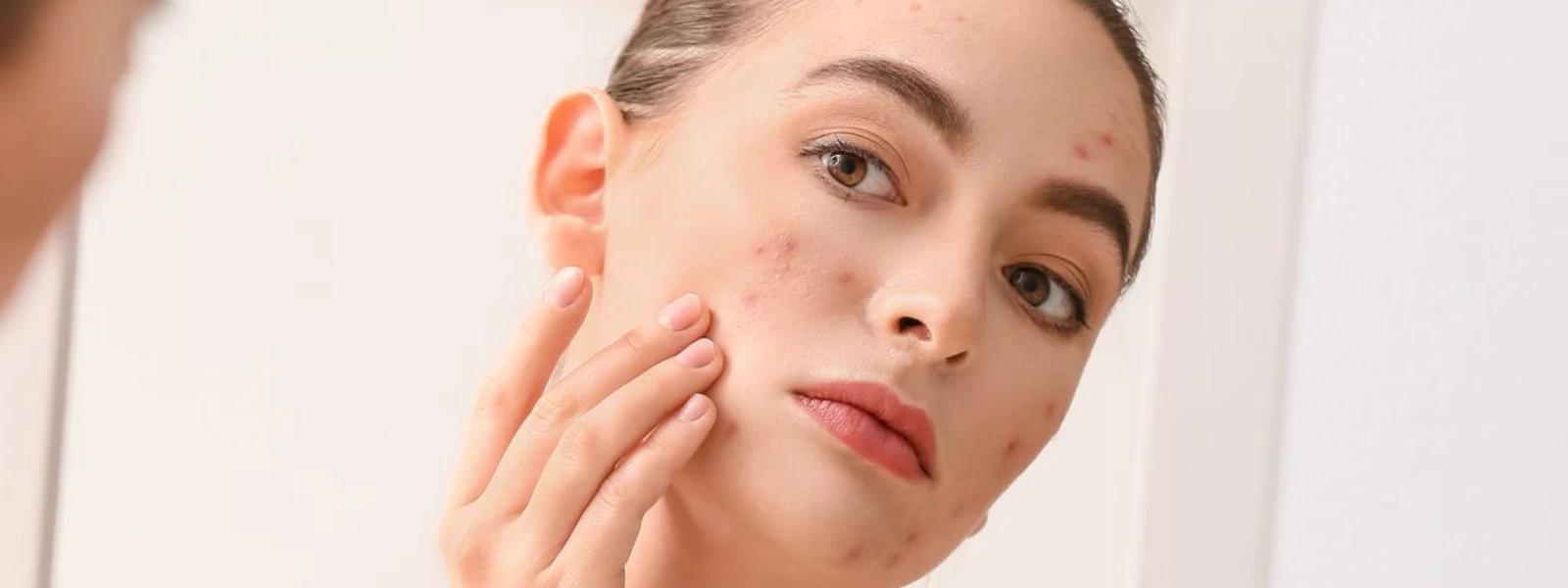 Indian Skin Hyperpigmentation Causes FAQ: Your Questions Answered